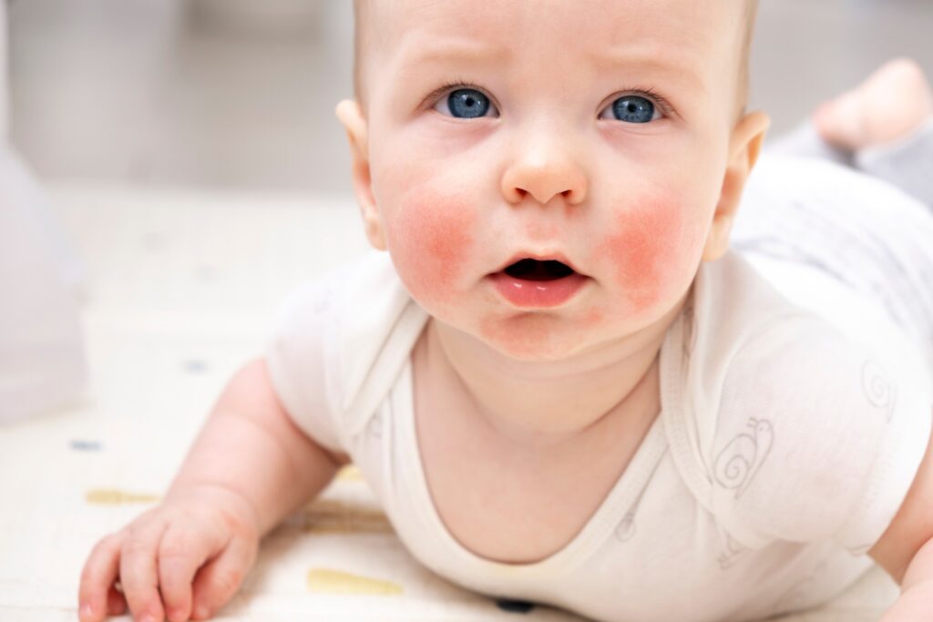 Natural remedies for soothing baby eczema—gentle, non-toxic solutions to relieve itchy, irritated skin.